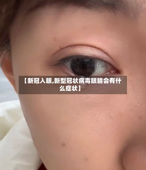 【新冠入眼,新型冠状病毒眼睛会有什么症状】
